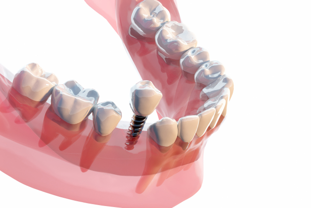 秦野市の歯医者、あめみや歯科医院でインプラント治療