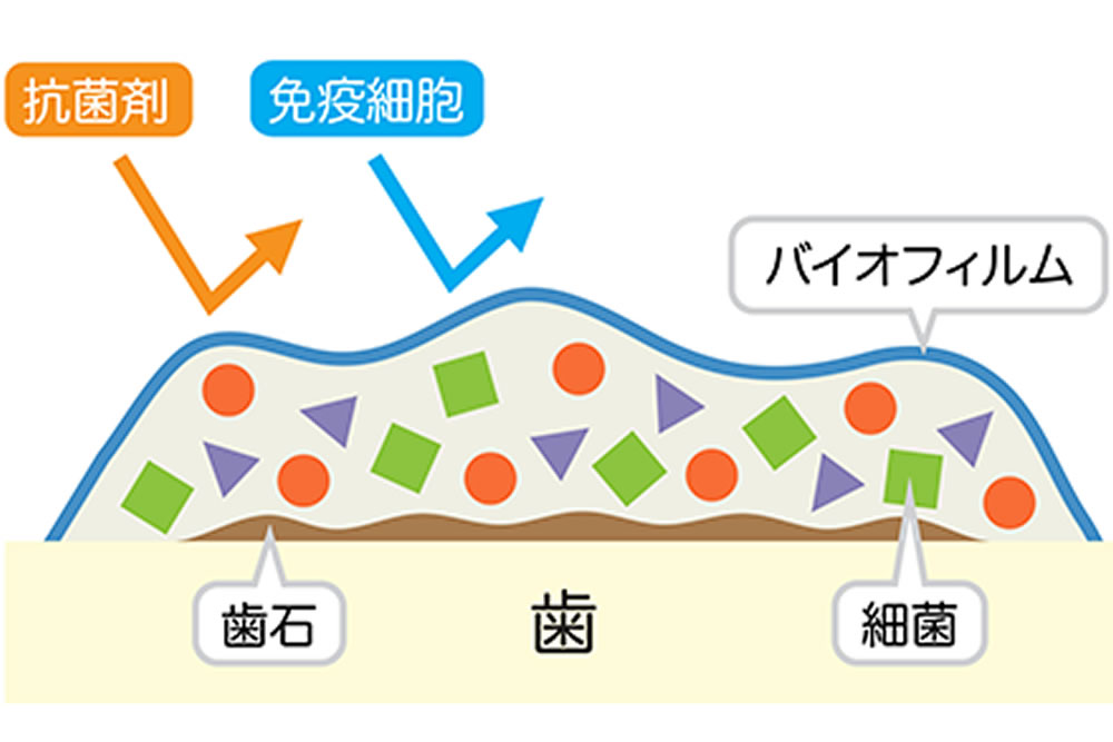 秦野市の歯医者、あめみや歯科医院で予防歯科