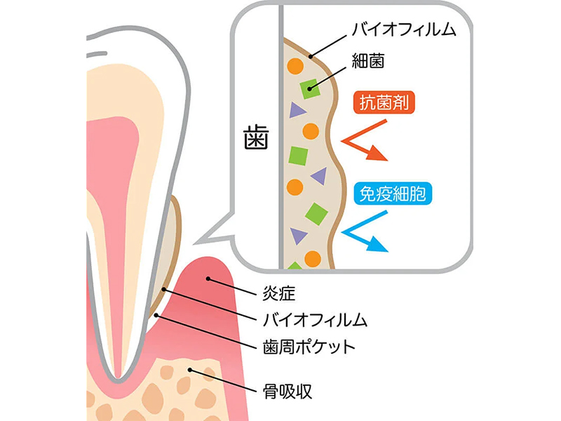 秦野市の歯医者、あめみや歯科医院で予防歯科