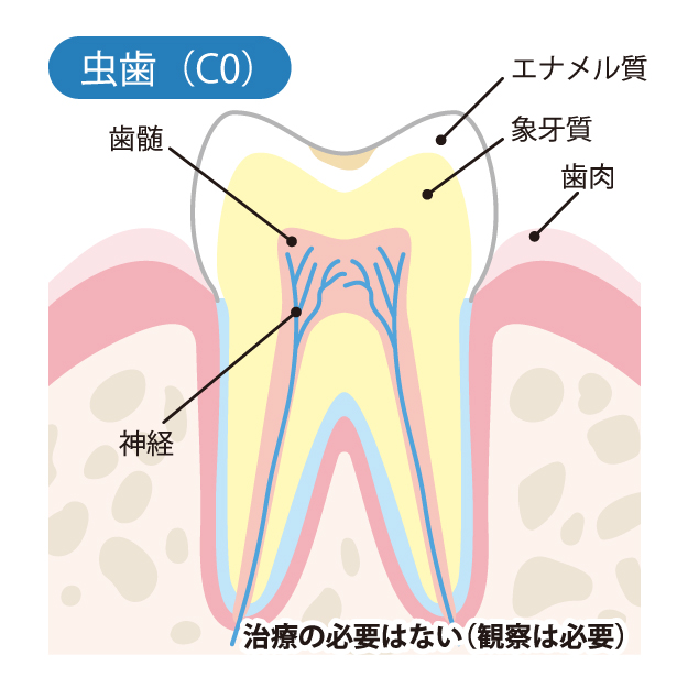 秦野市の歯医者、あめみや歯科医院でむし歯治療