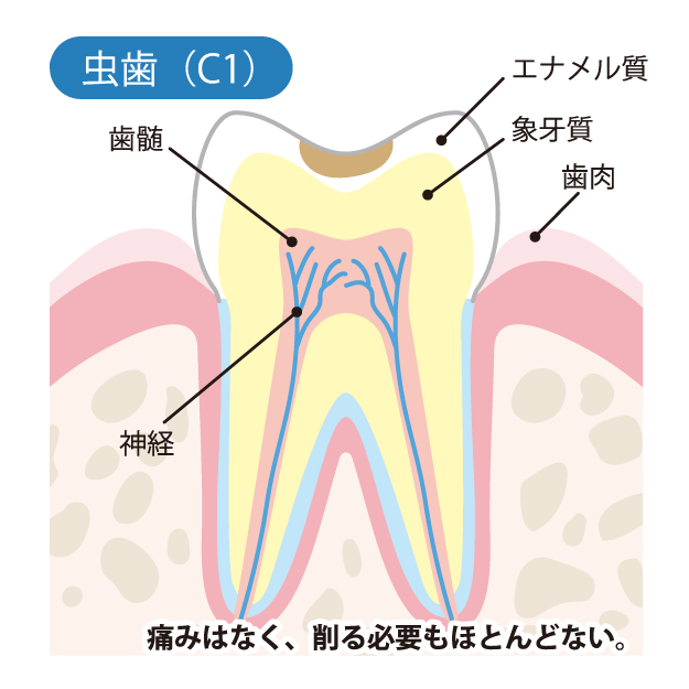 秦野市の歯医者、あめみや歯科医院でむし歯治療