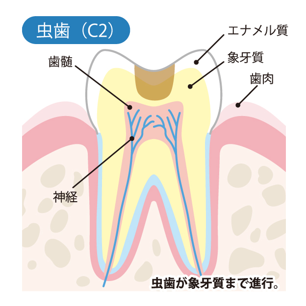 秦野市の歯医者、あめみや歯科医院でむし歯治療