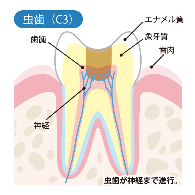 秦野市の歯医者、あめみや歯科医院でむし歯治療