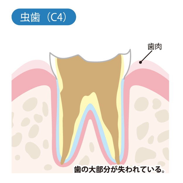 秦野市の歯医者、あめみや歯科医院でむし歯治療