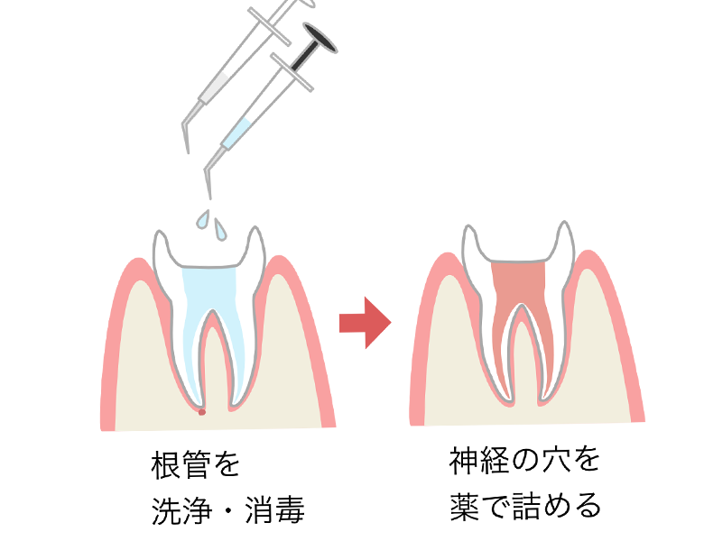 秦野市の歯医者、あめみや歯科医院で根管治療