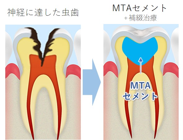 秦野市の歯医者、あめみや歯科医院のMTAセメント