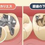 秦野市の歯医者、東海大学前駅徒歩0分の、あめみや歯科医院のむし歯の基礎知識についての解説